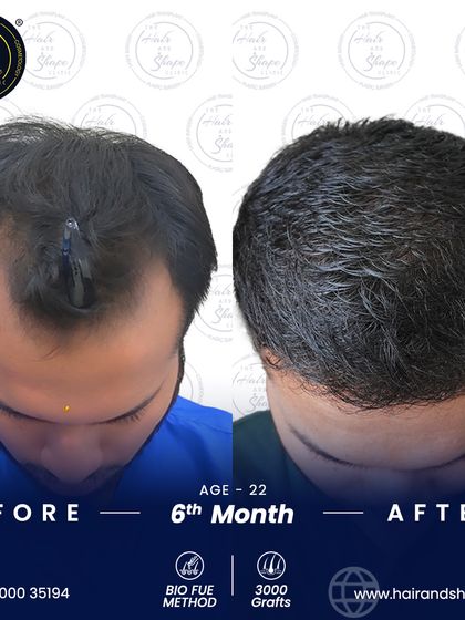 At only 22 years old, this patient chose to address his hair loss early. This is his 6-month result after a 3000-graft BIO FUE transplant.