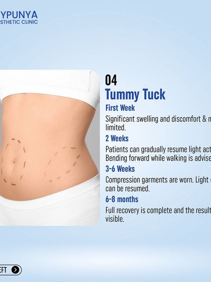 A detailed look at the tummy tuck recovery timeline. Patients are advised to bend forward while walking for the first 2 weeks, with light cardio resuming at 3-6 weeks.