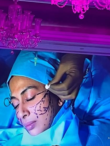 This image from a live demonstration shows the strategic placement of Aptos threads for a non-surgical facelift. These threads are used to lift sagging tissues and stimulate collagen for a rejuvenated and defined facial structure.