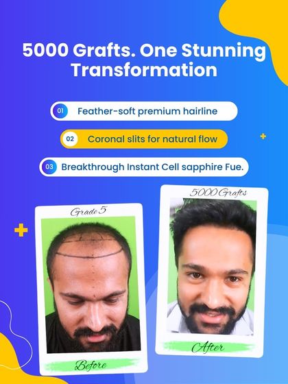 From Grade 5 baldness to a full head of hair. This 5000 graft transformation using our Instant Cell Sapphire FUE technique shows what is possible with advanced methods and artistic hairline design.