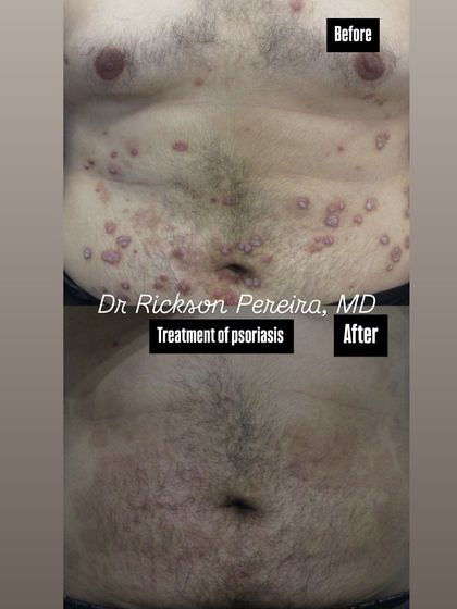 This image shows the resolution of psoriatic plaques on the abdomen. Unlike messy creams, biologic therapies work systemically to provide clear skin and are a more convenient option for widespread psoriasis.