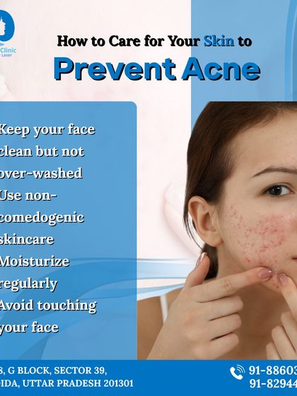 A guide on how to care for your skin to prevent acne. Simple habits like using non comedogenic products and moisturizing regularly are fundamental to keeping your skin clear.