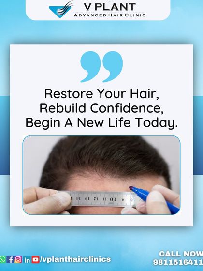 The first step to restoring your hair is designing the perfect hairline. This image shows the meticulous planning phase, where we use precise measurements to create a natural and flattering hairline for the client.