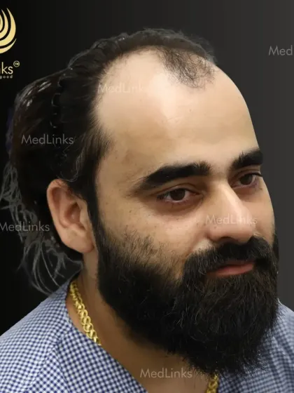 The patient's hair before the transplant, showing significant balding that affected his appearance.