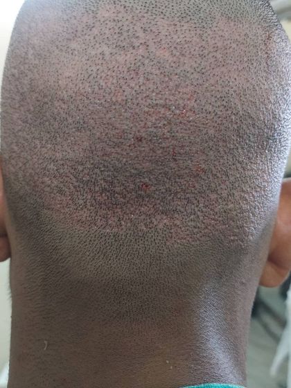 This is the donor area at the back of the head immediately after graft extraction. Our precise FUE technique ensures minimal scarring and quick healing.