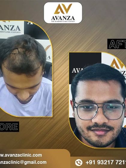 From a receding hairline and thinning top to a full and confident look. This client's smile in the after photo shows his satisfaction with the results.