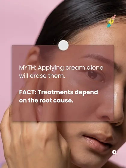 A common myth is that applying cream alone will erase dark circles. The fact is, the right treatment depends entirely on the underlying cause, which requires a professional diagnosis.