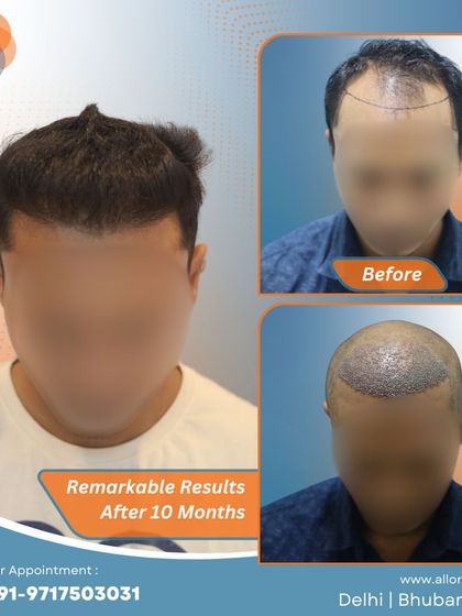 These images show the remarkable results after 10 months, including the planning stage. It's a clear demonstration of how careful planning leads to a successful and natural-looking outcome.