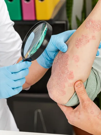 A correct diagnosis is the first step to effective treatment. Here, I am examining a case of psoriasis, a chronic condition that requires a careful, long-term management plan. My approach goes beyond just treating the visible patches; it's about understanding your triggers and creating a sustainable plan to manage flare-ups and improve your quality of life.
