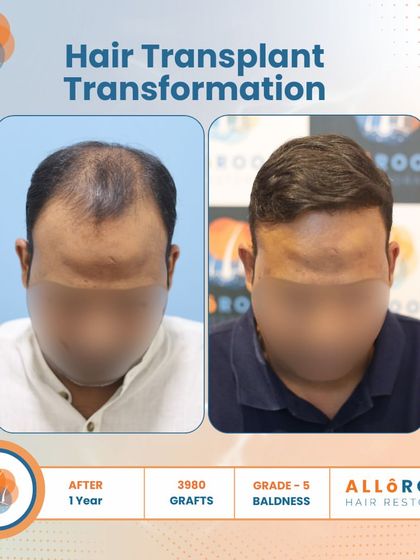 A one-year transformation for a Grade 5 baldness case using 3980 grafts. The images show the before, the immediate post-op, and the final result, demonstrating the entire process and its successful outcome.