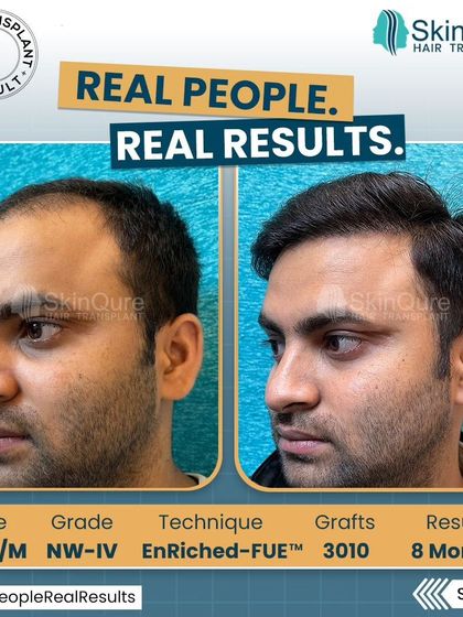 Another angle of the 28-year-old patient's 8-month result. This view highlights the excellent coverage achieved on the top of the scalp, creating a full and healthy look.