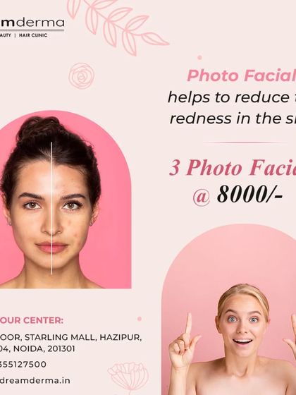 A before-and-after comparison showing how a Photo Facial helps reduce redness and even out skin tone, available in a special package offer.