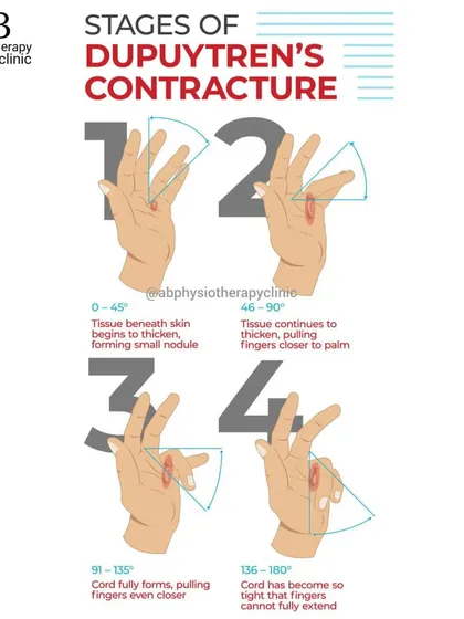 The four stages of Dupuytren's Contracture, a condition where tissue in the palm thickens and pulls the fingers inward. Early physiotherapy can help maintain flexibility.
