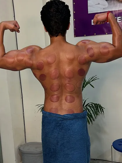 Fitness model Sumit showing the after-effects of cupping on his back.