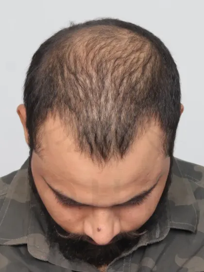 An incredible 8-month transformation for a Diffuse Grade 5A patient. With 4500 grafts, we recreated his hairline and restored the frontal and mid-scalp.