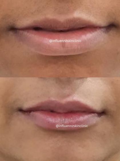 Here, we've enhanced the lips to create a fuller, more balanced appearance that complements the client's facial features.