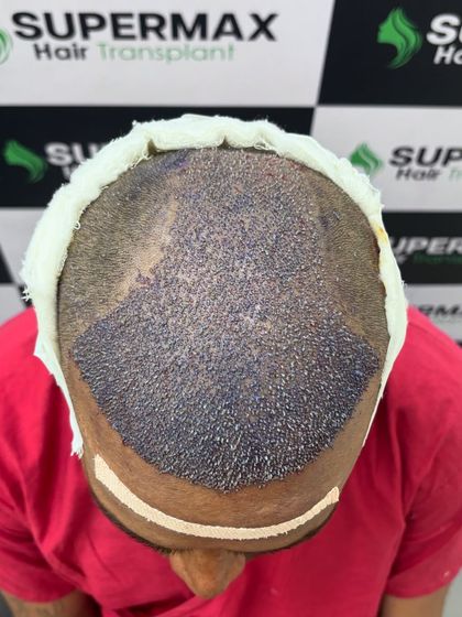 Another view of the 5400 grafts implanted in a single day. We work efficiently to give you maximum results.