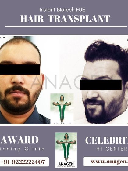 An excellent result from our Instant Biotech FUE hair transplant. The before and after photos clearly show the restoration of a full and natural hairline.