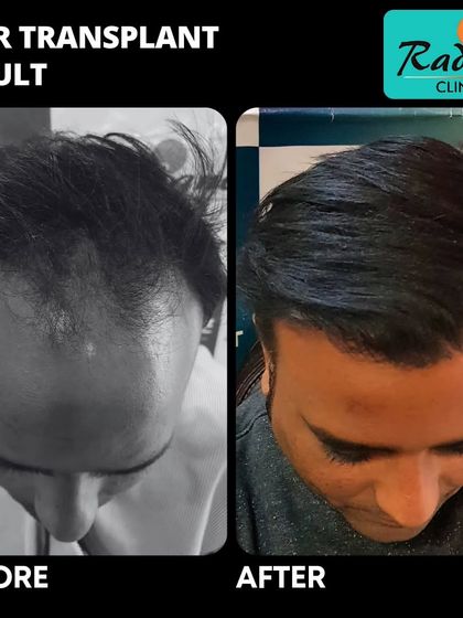 A top-down view of the same patient as in image 84. This angle clearly shows how we filled in the thinning areas to create a full and dense appearance across the scalp.
