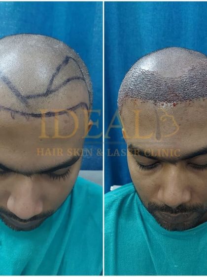 A before and after look at the implantation phase from a frontal perspective. The new grafts are densely packed to create a strong, new hairline.