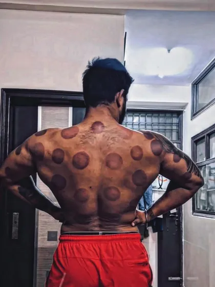 This is the result of a therapeutic dry cupping session on an athlete's back. This technique is excellent for releasing deep muscle tension, improving blood flow, and accelerating recovery after intense training, helping you perform at your best.