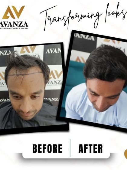 This client's thinning frontal area was completely restored. The after photo shows a strong, dense hairline and a much more youthful appearance.