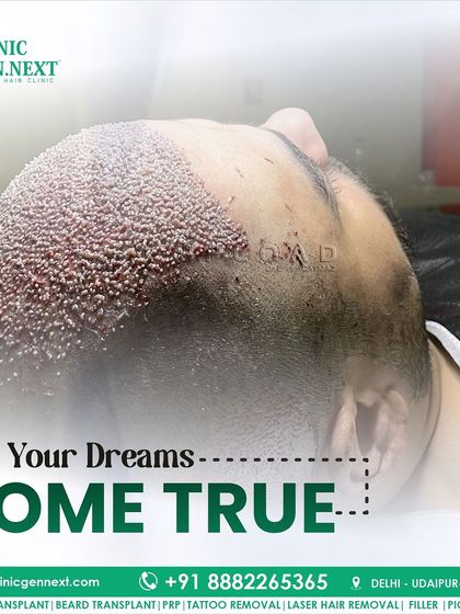 This image of a freshly completed transplant shows the density of the implanted grafts. This is how we make the dream of a full head of hair come true.