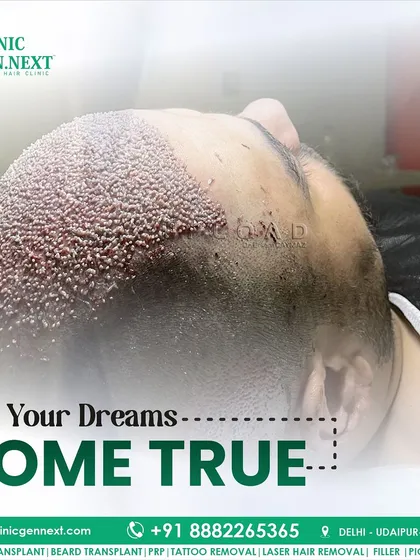 This image of a freshly completed transplant shows the density of the implanted grafts. This is how we make the dream of a full head of hair come true.