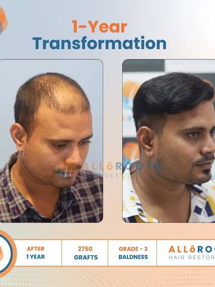 This one-year transformation for a Grade 3 baldness case was achieved with 2750 grafts. The series of photos demonstrates the significant improvement in density and hairline from every angle.