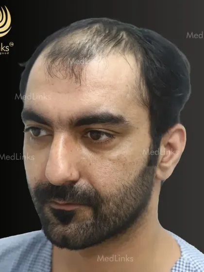 This patient's before photo shows significant hair loss, a common concern that brings many to our clinic. We see this as an opportunity to restore not just hair, but also self-confidence.