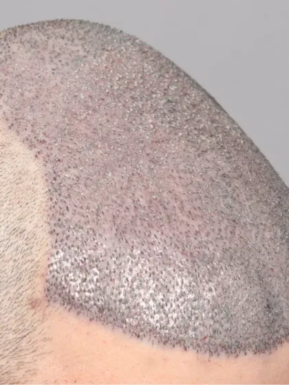 Another repair case for a Norwood Grade 6 patient. We used 5000 grafts to correct the previous work and provide a natural, dense result.