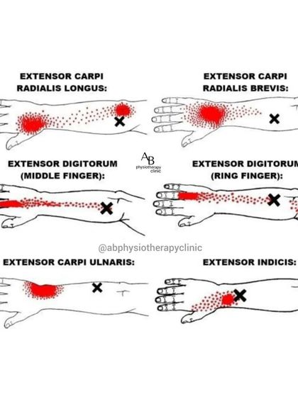 This chart shows the referred pain patterns from different trigger points in the forearm muscles. We are skilled at locating and releasing these trigger points to relieve hand and wrist pain.
