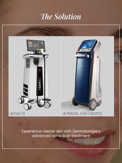 My clinic utilizes advanced technology like the AdvaTx and Ultracel devices to provide cutting-edge solutions for acne scar treatment and skin tightening.