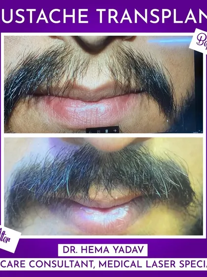 A patchy mustache can be easily corrected. Here you can see a clear before-and-after of a mustache transplant, where we significantly increased the density and created a fuller, more defined shape. This is a permanent solution for a stronger look.