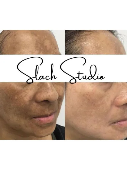 See the dual-action results on both the forehead and cheeks. This treatment effectively reduces widespread pigmentation for a more uniform skin tone.