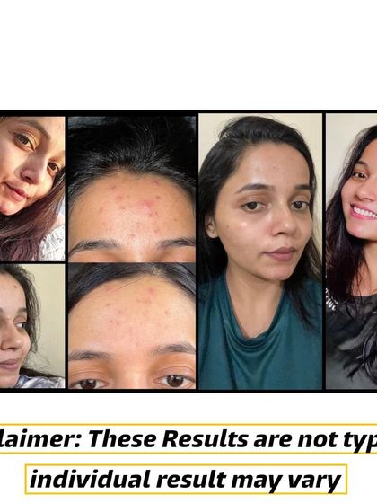 A closer look at the incredible skin transformation my client achieved. Our program focuses on healing from the inside out, which reflects on your skin.