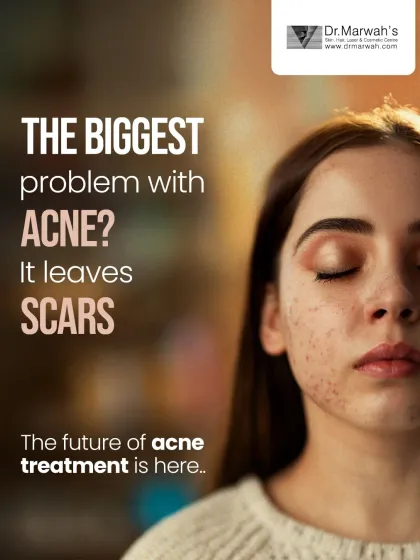The biggest problem with acne is that it often leaves behind scars that affect confidence long after the breakouts have cleared. We focus on not only treating active acne but also preventing and correcting the scars it leaves behind.
