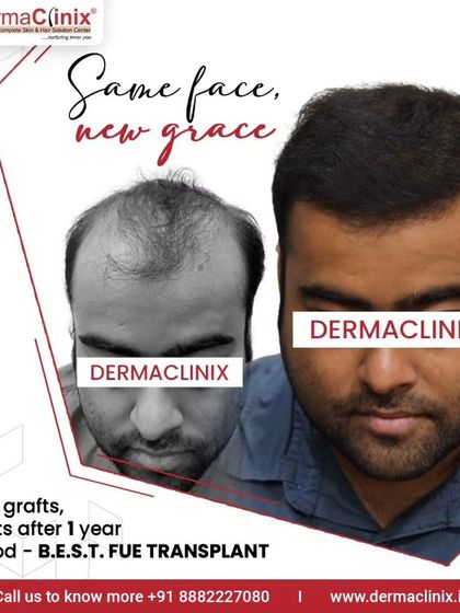 Same face, new grace. A one year result after a 4468 graft B.E.S.T. FUE transplant performed by Dr. Kavish. This is a clear example of how hair restoration is a blend of art and surgical skill.