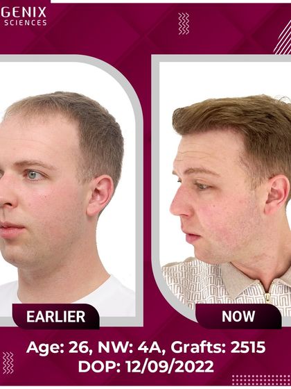 A complete before-and-after set of a 26-year-old patient from the UK, showcasing a restored hairline and youthful appearance.