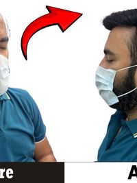 Non-Surgical Hair Replacement (Hair Patches & Systems)