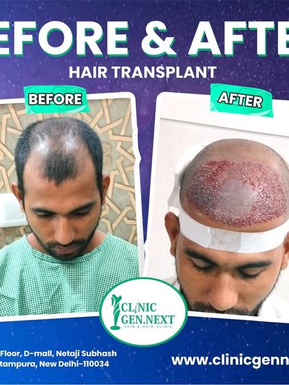 This image shows the patient's hair loss pattern before and the scalp immediately after the transplant, with all the new grafts in place.