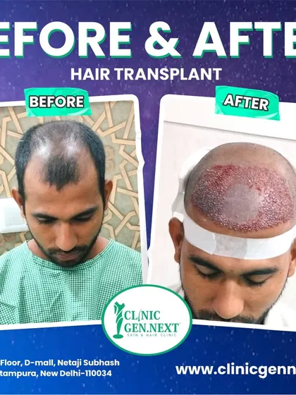 This image shows the patient's hair loss pattern before and the scalp immediately after the transplant, with all the new grafts in place.