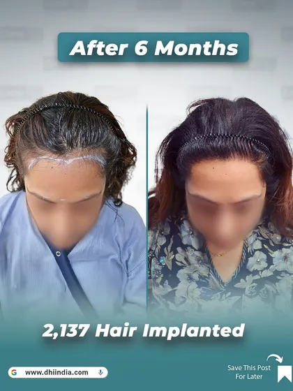 A top-down view of the same female client's 6-month progress. This angle clearly shows the increased density and coverage along her part, demonstrating the effectiveness of our specialized female hair restoration.