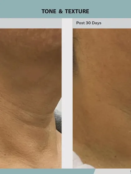 Another view of neck rejuvenation, this image shows how ADVA Tx can soften deep-set lines and improve the overall quality of the skin.