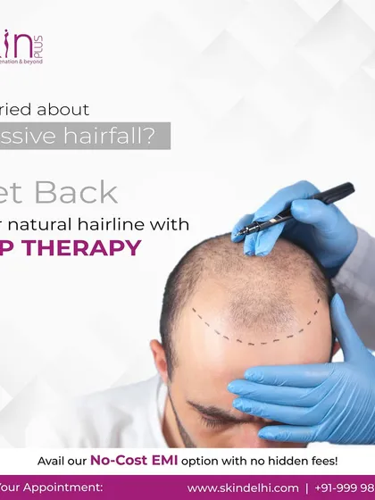 For clients concerned about a receding hairline or significant hair fall, PRP therapy is an excellent solution. This image shows how I map out the treatment area to ensure the therapy precisely targets the areas that need it most.