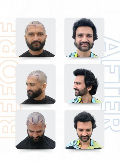 Voice Actor Mr. Rajesh Kava wanted to stop feeling defined by his hair loss. I mapped his hairline and placed 2,732 grafts using the RT-FUE technique to rebuild what he felt he’d lost. The change is real, and he looks like himself again.