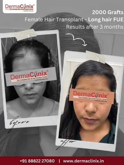 This is a 2000 graft Long Hair FUE transplant for a female patient, with results shown just three months post procedure. This technique is particularly beneficial for women as it requires no shaving, allowing them to resume their routine without any noticeable signs of surgery.