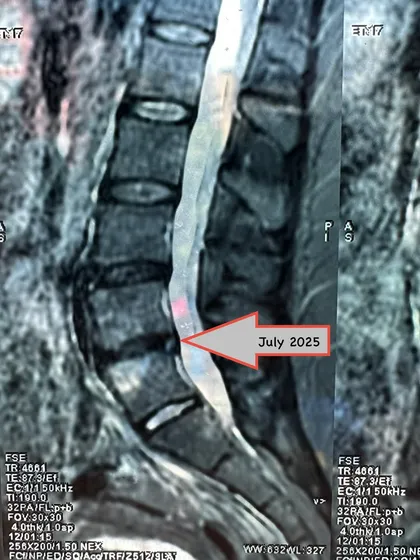 Here is the follow-up MRI after nine months of consistent, non-surgical physiotherapy. The disc has almost completely retracted, and the patient is now pain-free. This is the power of trusting the process.