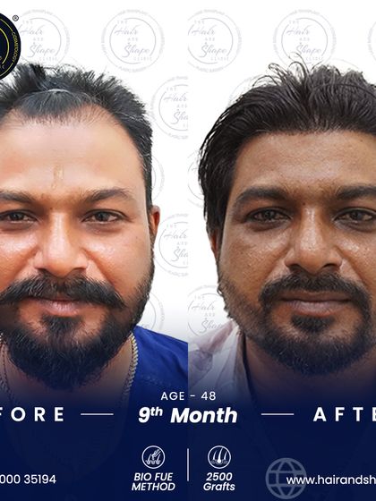 A frontal view of the 9-month BIO FUE result. The restored hair blends perfectly, creating a natural and fuller appearance.