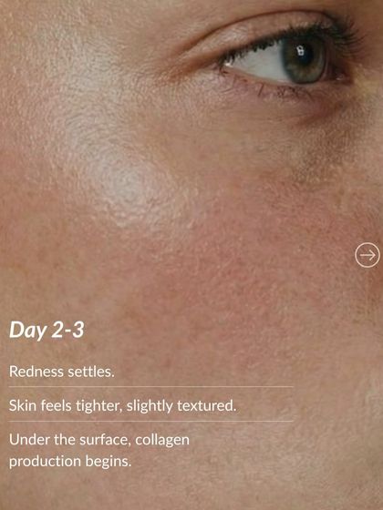 Day 2-3 after microneedling: The initial redness begins to settle, and your skin may feel tighter. Beneath the surface, the crucial process of collagen production has started.